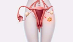 Endometriose